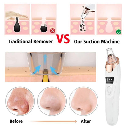 Smart Blackhead Vacuum